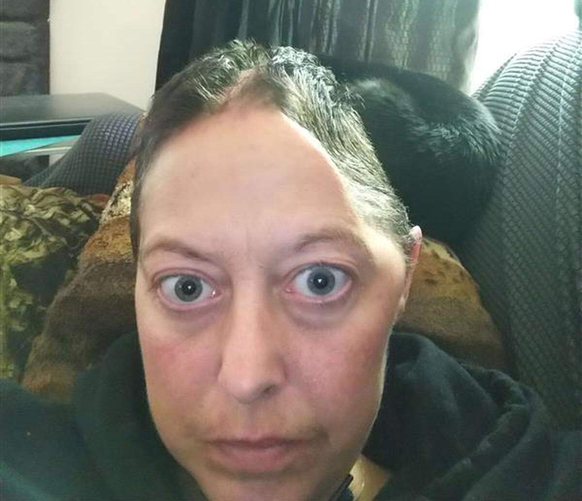 Photo of Nicole McClure following her first surgery after suffering a brain bleed on March 21-22, 2022. Trooper Jonathan Barnes mistook her symptoms for intoxication and booked her into the Thurston County jail where she was allegedly mistreated and neglected, a lawsuit claims.