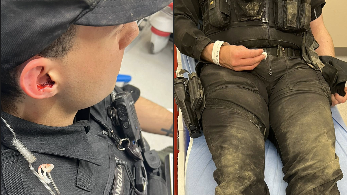 Thurston County Sheriff Derek Sanders shared two images of injured deputies from an area hospital on Tuesday, May 13, 2025. The deputies fought a man suspected of felony harassment, Sanders said.