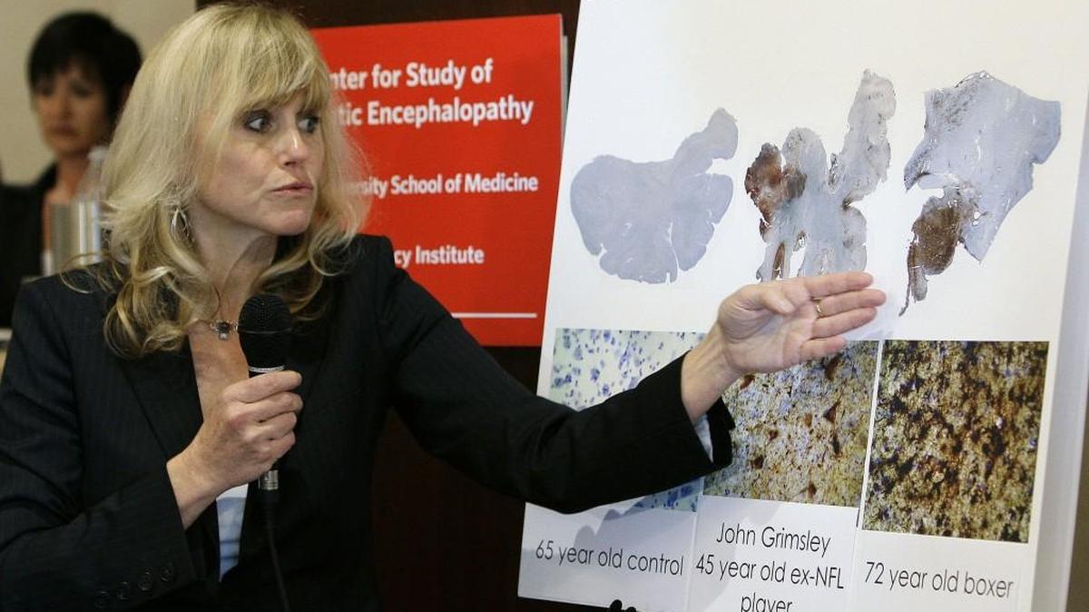 In this Tuesday Jan. 27, 2009, file photo, Dr. Ann McKee, of Boston University School of Medicine, talks about damaged human brains during a news conference about chronic traumatic encephalopathy in Tampa, Fla. Jeff Miller, the NFL’s senior vice president for health and safety, acknowledged a link between football and the brain disease CTE for the first time this past Monday.